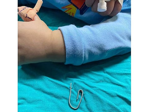 One of the clips removed from the baby.