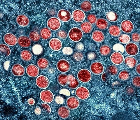 This image provided by the National Institute of Allergy and Infectious Diseases (NIAID) shows a colourised transmission electron micrograph of monkeypox particles (red) found within an infected cell (blue), cultured in the laboratory that was captured and colour-enhanced at the NIAID Integrated Research Facility (IRF) in Fort Detrick, Md.