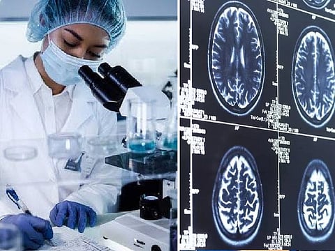 Results of the 18-month study on lecanemab that included nearly 1,800 people in the earliest stages of Alzheimers disease were presented at an Alzheimer’s meeting in San Francisco and published in The New England Journal of Medicine.