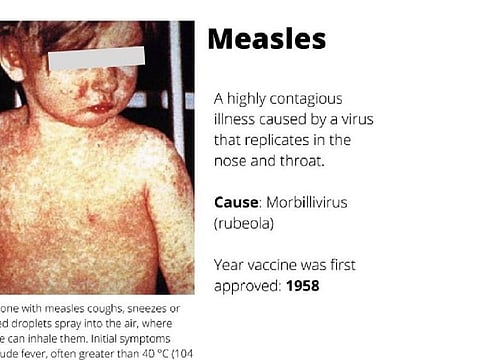 Measles cases in South Africa rise to 227
