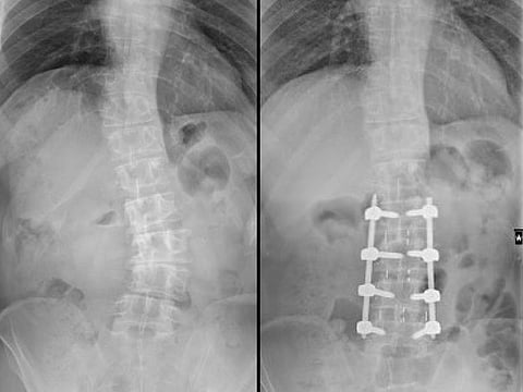 Combo X-ray image showing the curved spine (left) and how it was straightened (right) after the surgery
