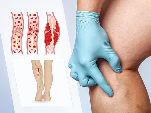 Deep vein thrombosis (DVT) occurs when blood clots form in a deep vein in the leg or the pelvis.