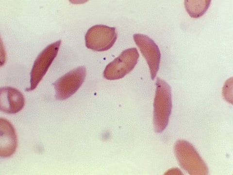 This microscope photo provided on October 25, 2023, by the Centers for Disease Control and Prevention shows crescent-shaped red blood cells from a sickle cell disease patient in 1972. Britain's medicines regulator has authorized the world's first gene therapy treatment for sickle cell disease, in a move that could offer relief to thousands of people with the crippling disease in the UK.