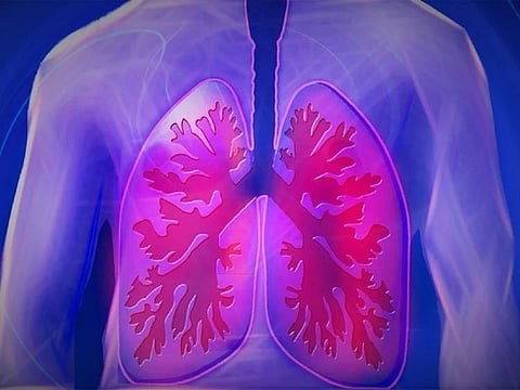 UAE: National programme to detect lung cancer early, offer better survival rates