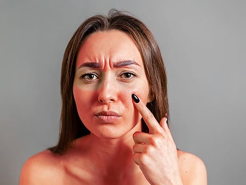 When you find yourself with a sunburn, don't apply ice to the burned area: Ice constricts the blood vessels and possibly aggravates the skin further.