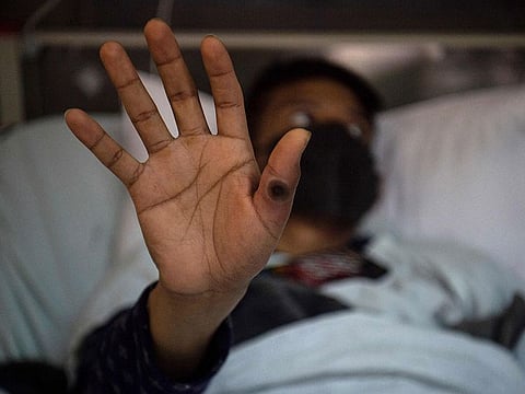 A surging mpox outbreak in Africa, which was declared an emergency by the continent's health agency on August 13, is being driven by a new, more transmissible strain of the virus. The Africa Centres for Disease Control and Prevention (Africa CDC) declared its first-ever Public Health Emergency of Continental Security (PHECS) for the deadly disease.