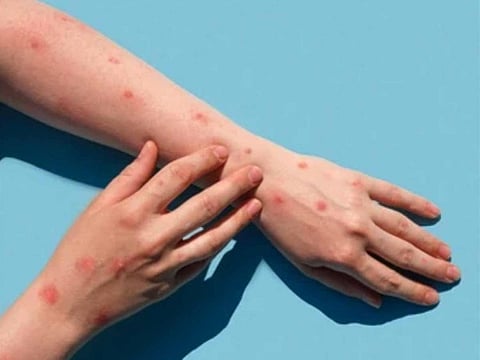 Illustrative image. The new mutated mpox strain is related to a more virulent version called clade I that appears to be spreading more quickly in children and adolescents, as well as through sexual contact.