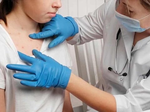 WHO declared mpox outbreak a global public health emergency