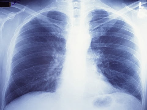 Another Deadly Disease for Smokers: Pulmonary Fibrosis