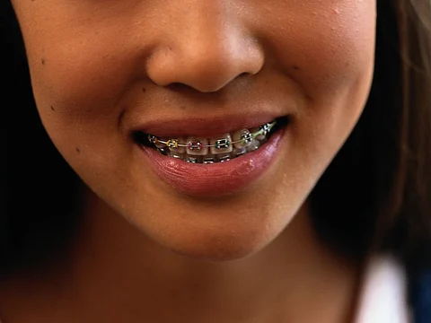 oral braces
