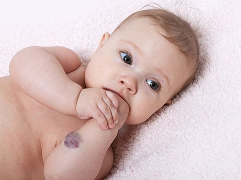 hemangioma