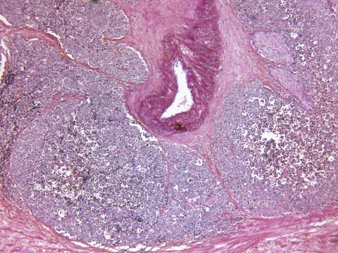 prostate cancer