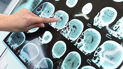 Odds for Dementia Nearly Triple in the Year After a Stroke
