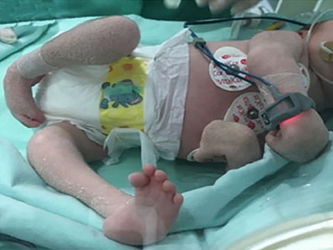 arthrogryposis