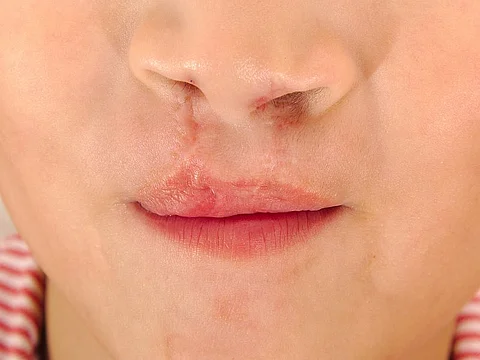 cleft lip