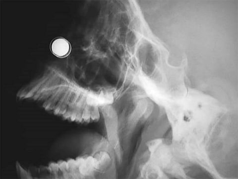 x-ray of embedded magnet