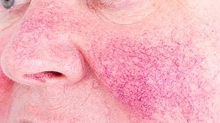 rosacea