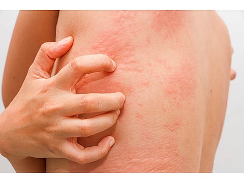 red rash on man\'s back