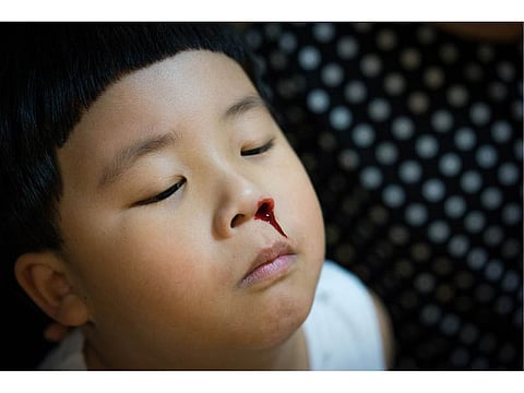 child\'s face bleeding from his nose