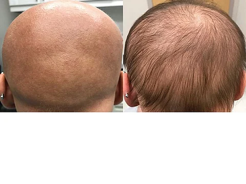 Patient 6 weeks and 11 months after treatment
