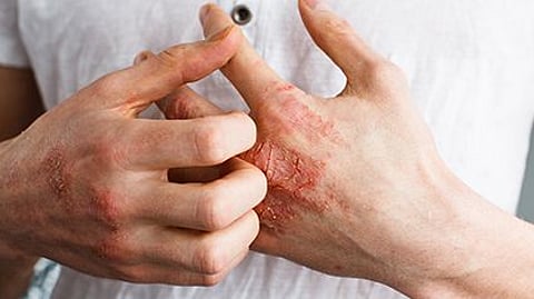 eczema