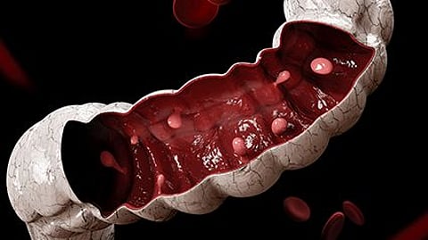 Less Recurrence Seen With Endoscopic Submucosal Dissection of Large Lesions