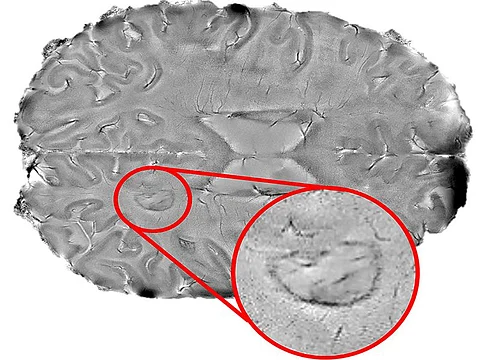 Dark-rimmed \'smoldering\' spot in the brain.