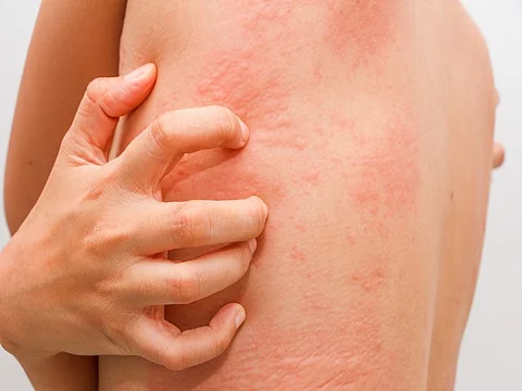 hives