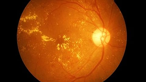 Minocycline Does Not Decrease Geographic Atrophy Enlargement in AMD