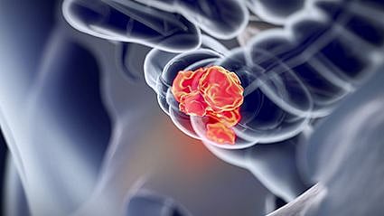 Type 2 Diabetes Linked to Increased Risk for Colorectal Cancer