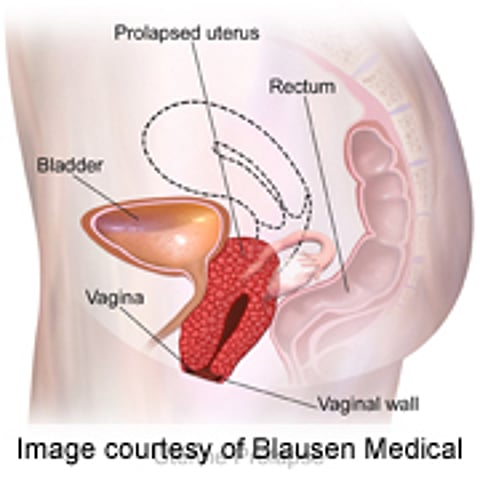 Pelvic Organ Prolapse Surgery Loses Effectiveness