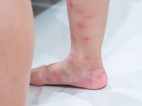 Blisters from fire ant bites