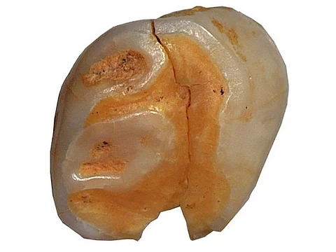 neanderthal tooth