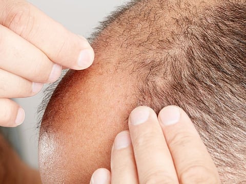 Could Hair Loss Drug Finasteride Help Men's Hearts?
