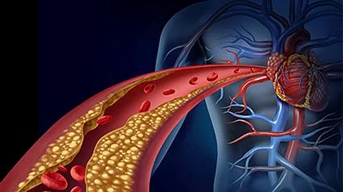 ¿Qué tipo de estent recibí, y dónde? La mayoría de los pacientes cardiacos no lo saben