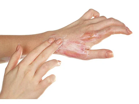 putting a cream on a burn hands