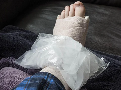 a foot in a cast with the ice-pack on the ankle