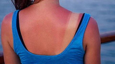 sunburn on a girl's back