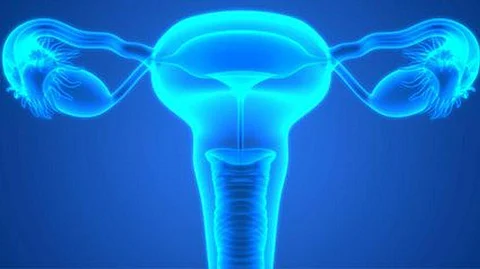 ovarian cancer