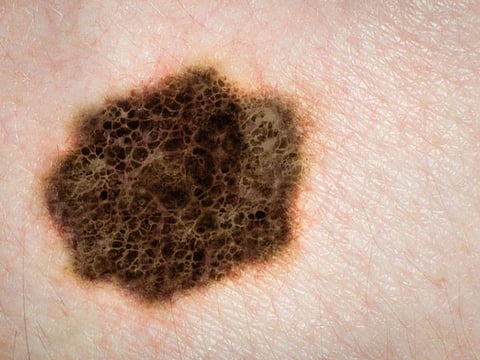skin cancer melanoma