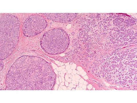 breast cancer biopsy
