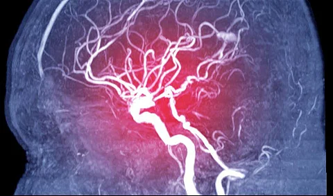 brain bleed aneurysm