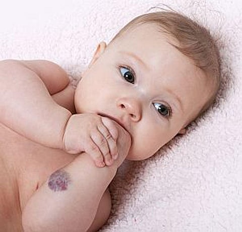 Oral Nadolol Feasible for the Treatment of Infantile Hemangiomas