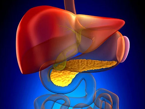Are You at Risk for Pancreatic Cysts?