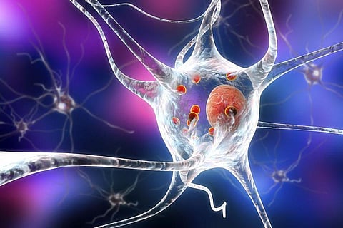 Risk for Parkinson's Disease Falls After a Heart Attack