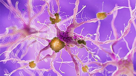 Trial Begins of Nasal Vaccine for Alzheimer Disease