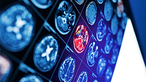 Risk for Ischemic Stroke Up With Antidopaminergic Antiemetic Use