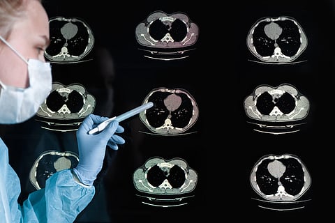 Coronavirus covid19, computed tomography of the lungs with pneumonia, coronavirus disease, diagnosis, examination, Thorax -Lung -Chest CT (Computed Tomography) High Resolution.CT scan..