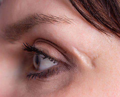 facial scar