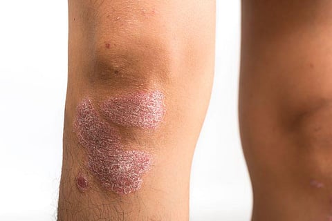 Biological Agent Trials for Psoriasis Rarely Include Patient Images